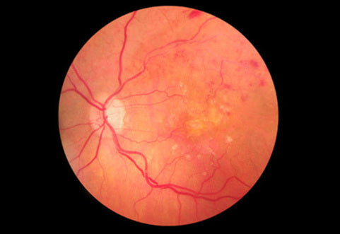 An-end-to-injections-for-AMD