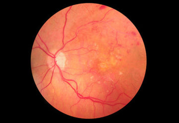 An-end-to-injections-for-AMD